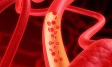 Akdeniz Anemisi Akdeniz Ateşi Belirtileri ve Tedavisi