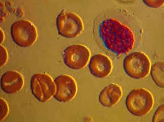 Akdeniz Ateşi Anemisi Belirtileri ve Tedavisi