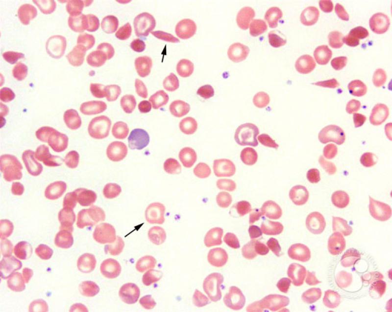 Akdeniz Anemisi Belirtileri ve Tedavisi